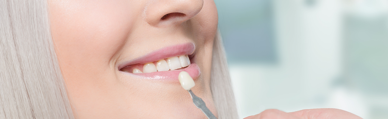 Процесс подбора виниров